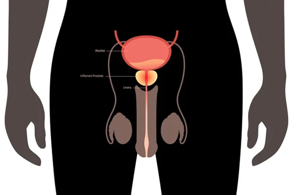 Laser Prostatectomy